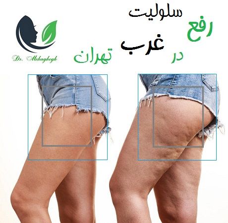 رفع سلولیت در غرب تهران