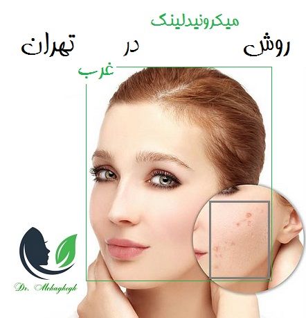 روش میکرونیدلینگ در غرب تهران