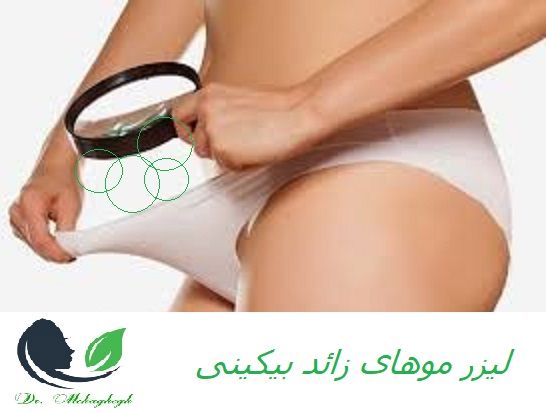 لیزر بیکینی