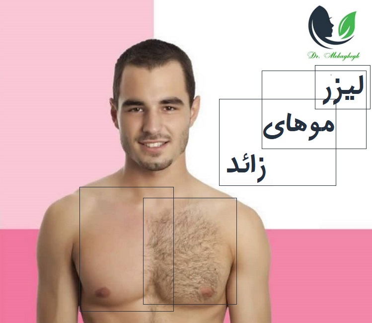 لیزر مو