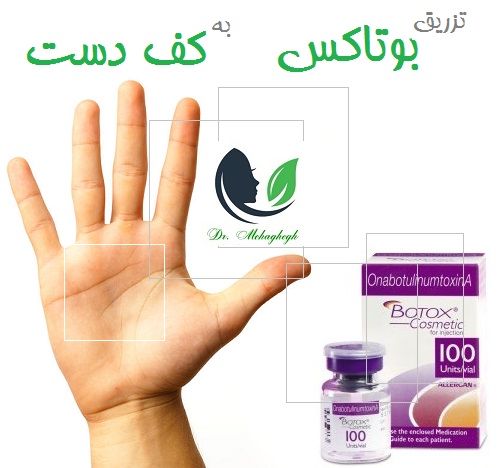 تزریق بوتاکس به کف دست