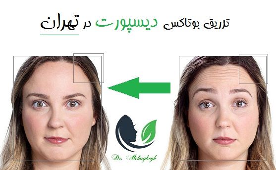 تزریق بوتاکس دیسپورت در تهران