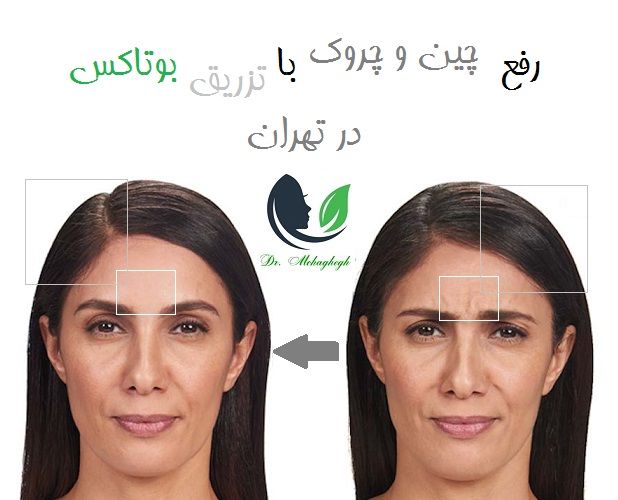 رفع چین و چروک با تزریق بوتاکس در تهران