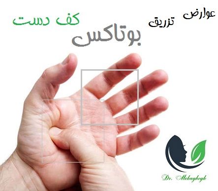 عوارض تزریق بوتاکس کف دست