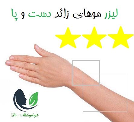 لیزر موهای زائد دست و پا