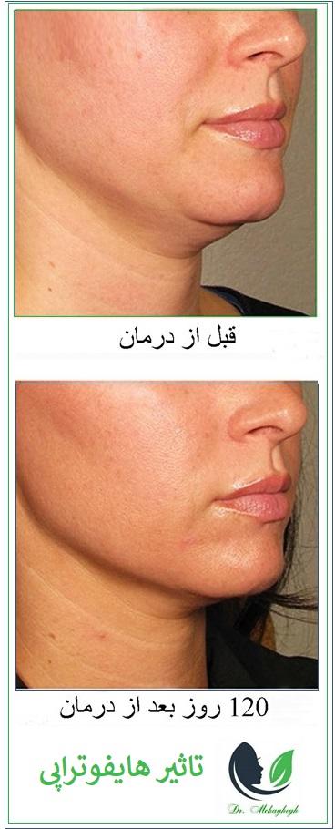 هایفوتراپی غرب تهران