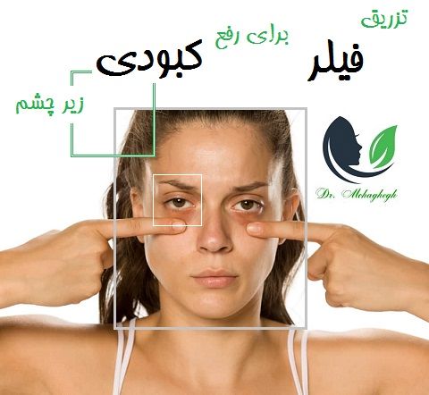تزریق فیلر برای رفع کبودی زیری چشم