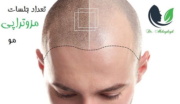 تعداد جلسات مزوتراپی مو