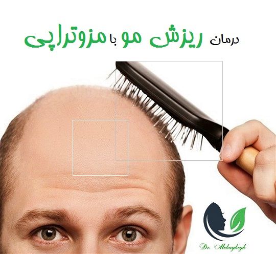 درمان ریزش مو با مزوتراپی