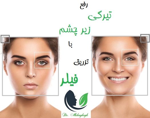 رفع تیرگی زیر چشم با تزریق فیلر