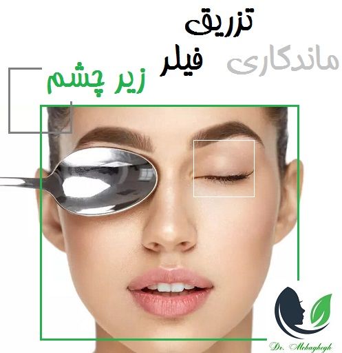 ماندگاری تزریق فیلر زیر چشم