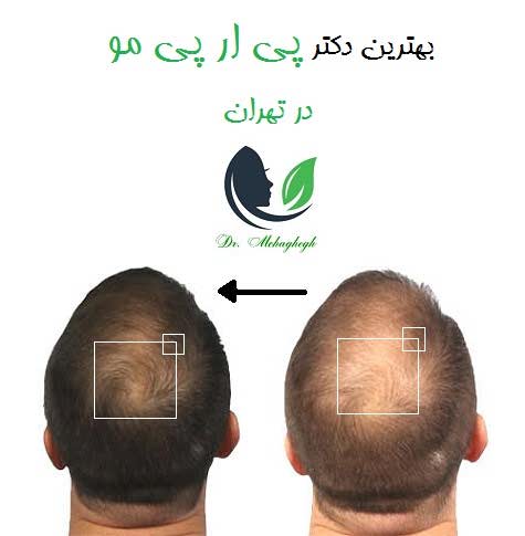 بهترین دکتر پی ار پی مو در تهران