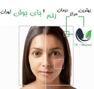 بهترین مرکز درمان زخم و جای جوش تهران