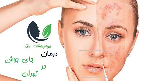 درمان جای جوش در تهران