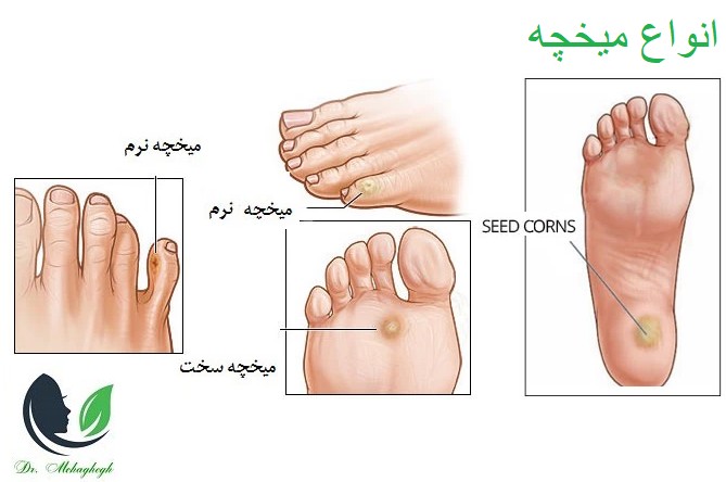 انواع میخچه
