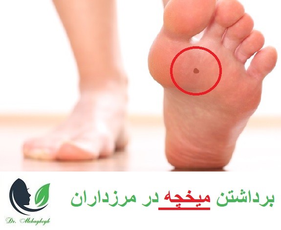 میخچه مشکلی دردناک