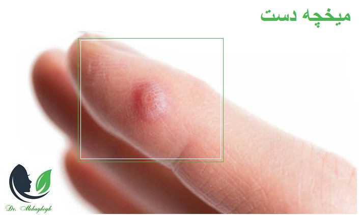 برداشتن میخچه دست در مرزداران 