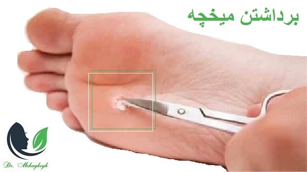برداشتن میخچه در مرزداران بدون درد