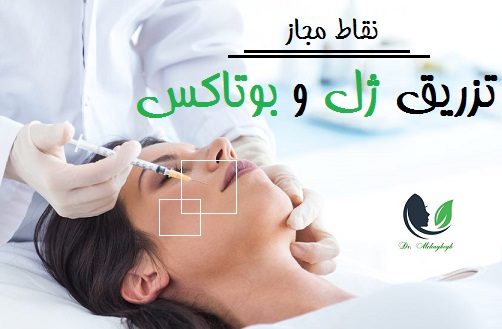 نقاط مجاز تزریق ژل و بوتاکس