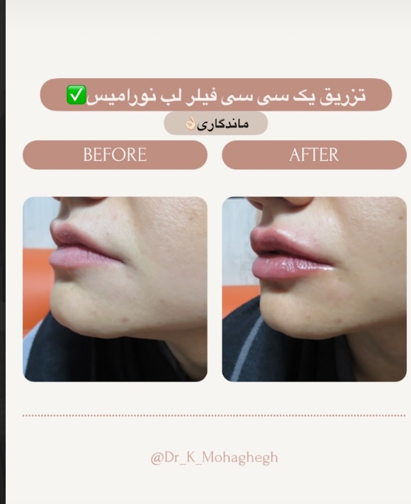 تزریق ژل و فیلر لب به روش روسی توسط دکتر کاظم محقق