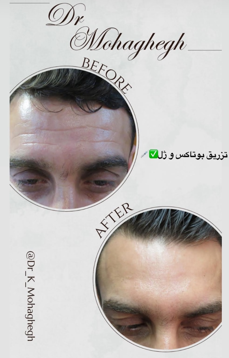 تزریق ژل و فیلر و بوتاکس برای رفع چین و چروک پیشنانی توسط دکتر کاظم محقق