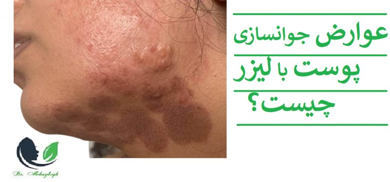 جوانسازی صورت با لیزر