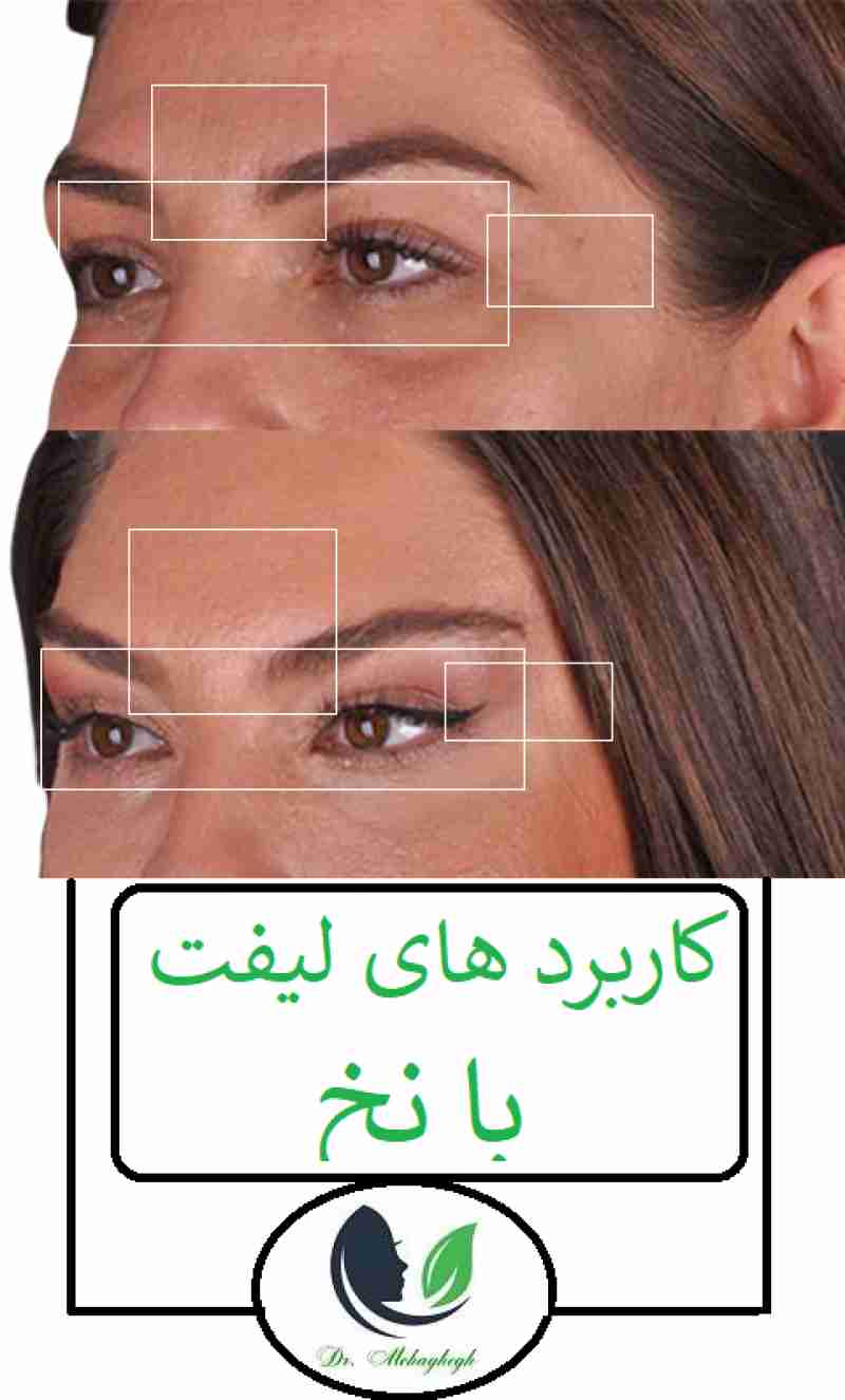 کاربرد های لیفت با نخ