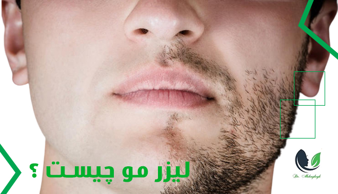 لیزر مو چیست؟