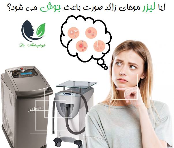 ایا لیزر موهای زائد صورت باعث جوش می شود؟