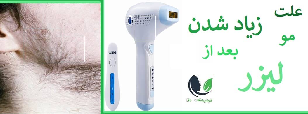 علت زیاد شدن مو بعد از لیزر