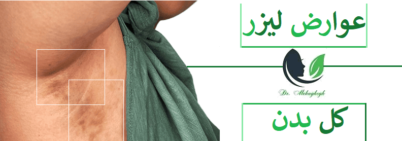 عوارض لیزر کل بدن