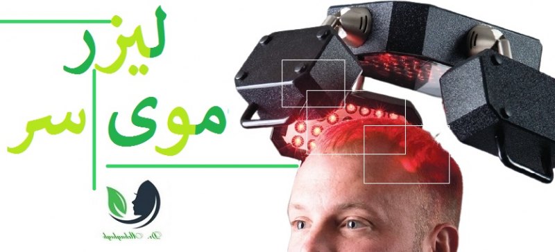 لیزر موی سر