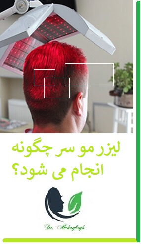 لیزر مو سر چگونه انجام می شود؟