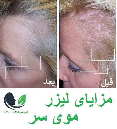 مزایای لیزر موی سر