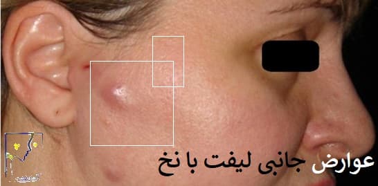 عوارض لیفت با نخ