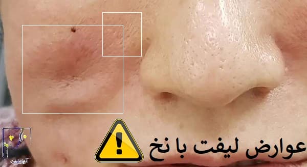عوارض لیفت با نخ