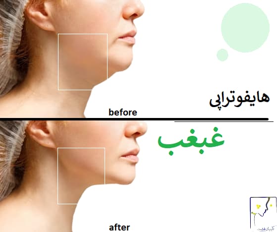 هایفوتراپی غبغب
