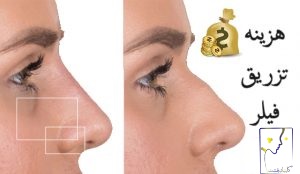 هزینه فیلر چقدر است؟