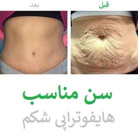 سن لازم برای هایفوتراپی شکم