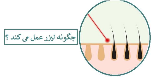 لیزر موهای زائد چگونه انجام می شود؟