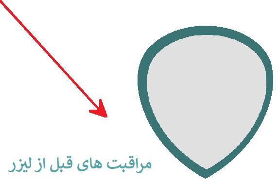 مراقبت های قبل از لیزر 