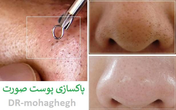 پاکسازی صورت در صادقیه