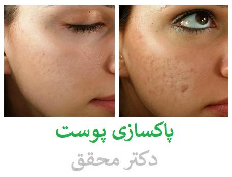 نحوه برداشتن سلول های ضعیف و مرده به چه صورت است؟