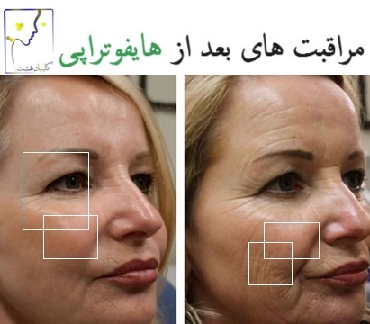 مراقبت های بعد از هایفوتراپی