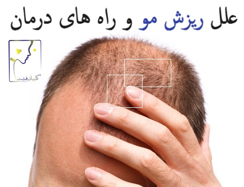 علل ریزش مو و راه های درمان