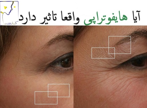 آیا هایفوتراپی واقعا تاثیر دارد؟