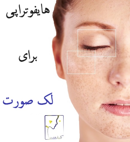 هایفوتراپی برای لک صورت