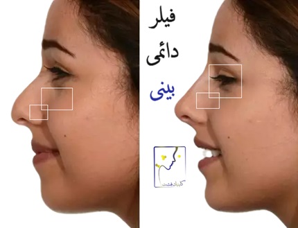 فیلر دائمی بینی