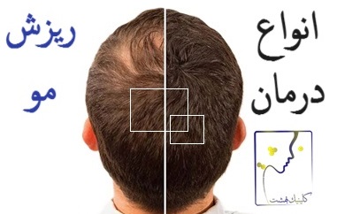 انواع درمان ریزش مو