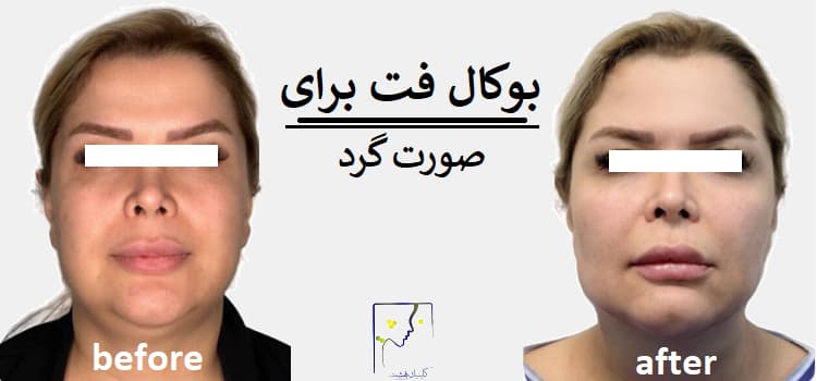 بوکال فت برای صورت گرد